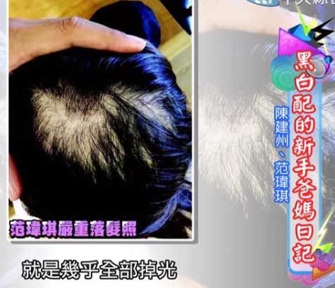 oasis hair spa loss hair 脫髮 頭髮護理 產後脫髮 植髮 3